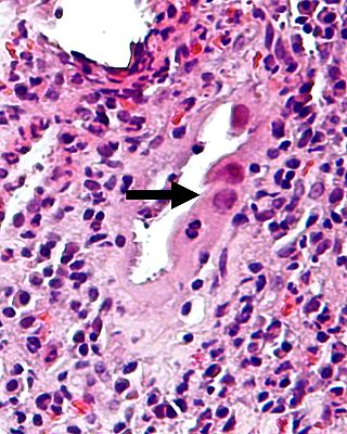 CMV-Kolitis